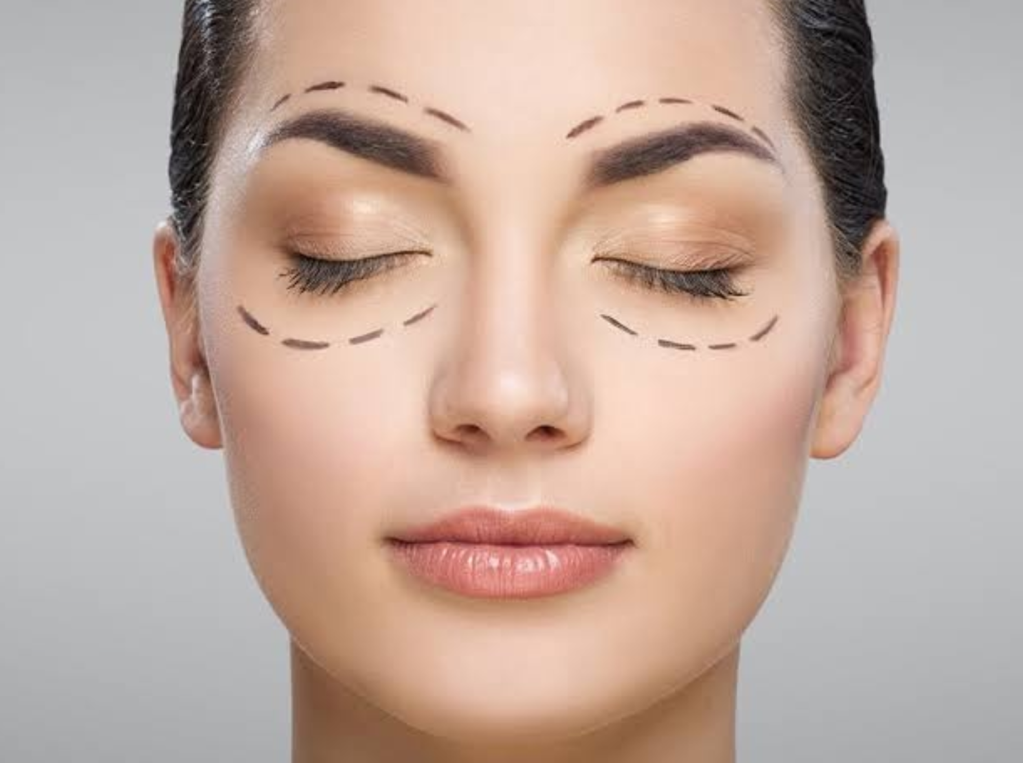 Blefaroplastia